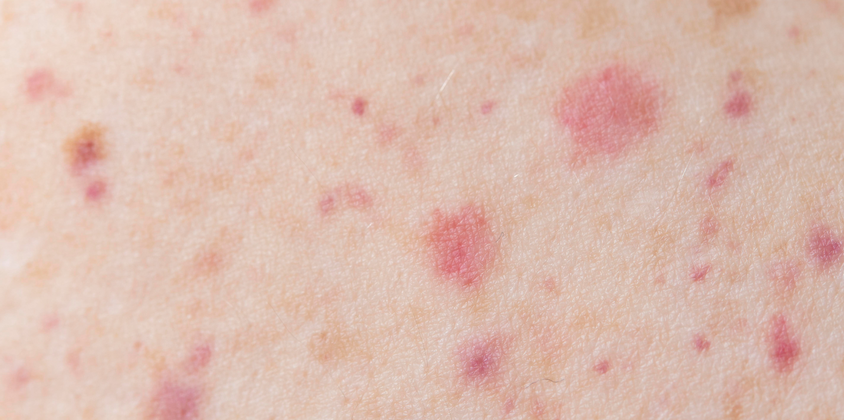 Folliculitis After Waxing: Causes, Prevention & Treatment