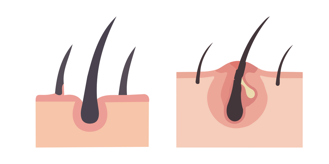 Folliculitis After Waxing: Causes, Prevention & Treatment