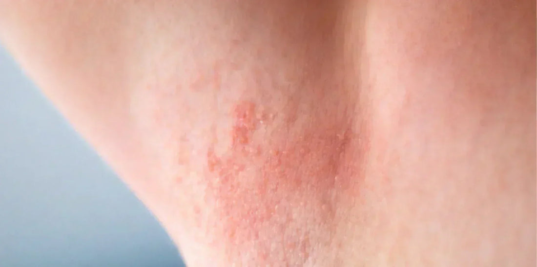 Histamine Reaction After Waxing: Causes, Symptoms & Care