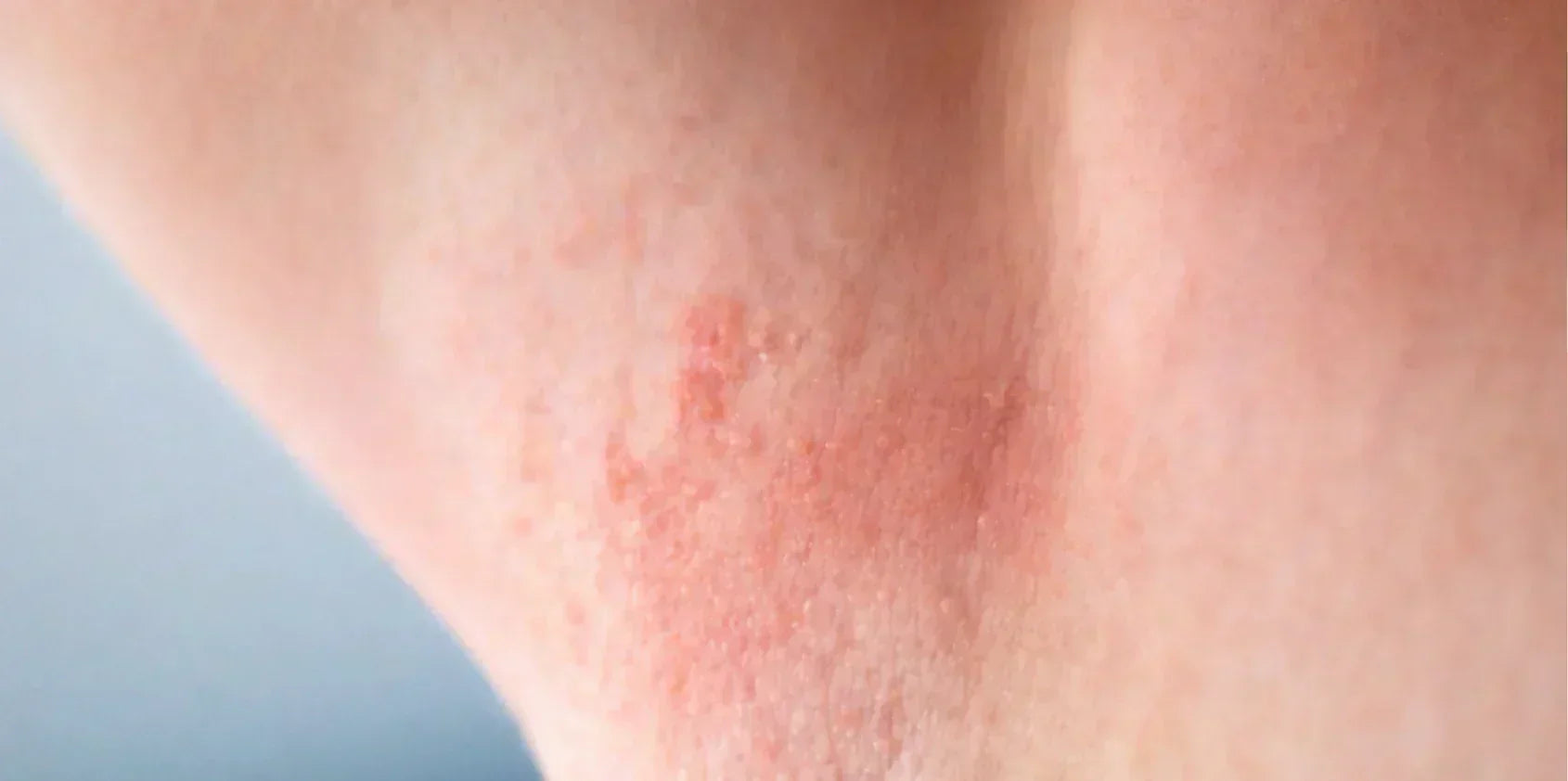 Histamine Reaction After Waxing: Causes, Symptoms & Care
